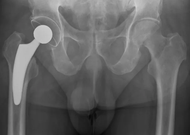 Röntgenbild eines Beckens mit implantierter Hüftprothese