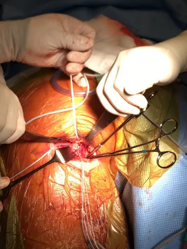 Refixation der Sehnen mit Fäden im Operationssitus