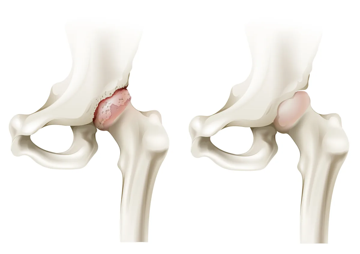 Vergleich eines gesunden Hüftgelenks mit einem arthrotisch veränderten Hüftgelenk